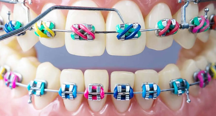braces color wheel on teeth